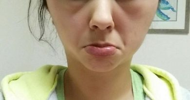14637609151976 desktop 1461690265 This Is The Reason You Should Invest In An EpiPen...Allergic Reactions Are Serious