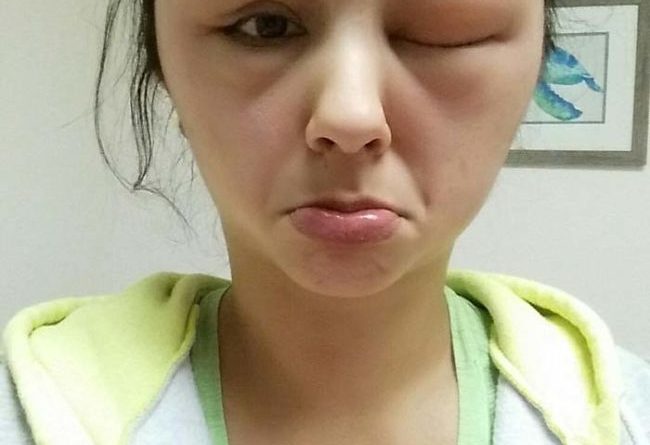 14637609151976 desktop 1461690265 This Is The Reason You Should Invest In An EpiPen...Allergic Reactions Are Serious