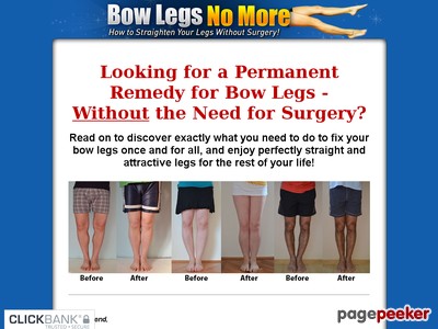 1507627325 d41d8cd98f00b204e9800998ecf8427e Bow Legs No More - How to Straighten Your Legs Without Surgery!
